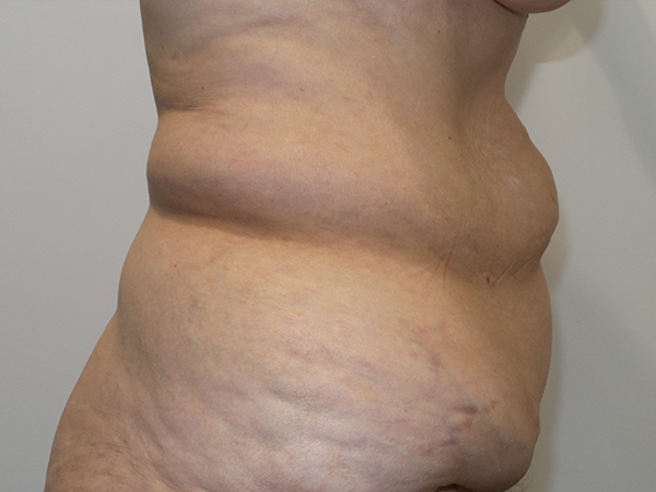 Belt Lipectomy Before and After 06 | Grover Aesthetics
