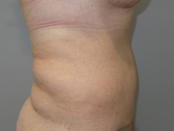 Belt Lipectomy Before and After 06 | Grover Aesthetics