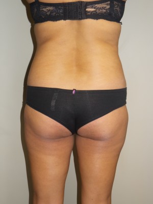 Butt Augmentation Before and After 01 | Sanjay Grover MD FACS
