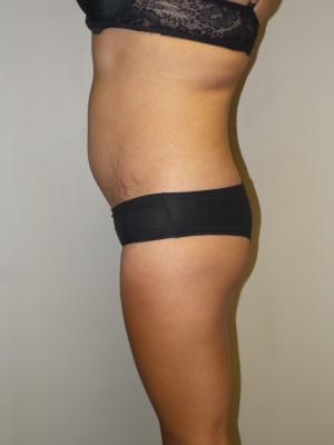 Butt Augmentation Before and After 01 | Grover Aesthetics