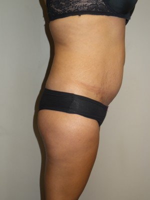 Butt Augmentation Before and After 01 | Grover Aesthetics