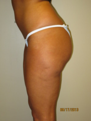 Butt Augmentation Before and After 02 | Grover Aesthetics
