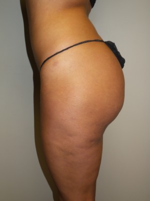 Butt Augmentation Before and After 02 | Grover Aesthetics