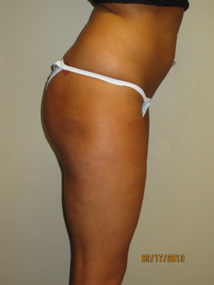Butt Augmentation Before and After 02 | Grover Aesthetics