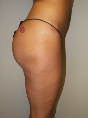 Butt Augmentation Before and After 02 | Grover Aesthetics