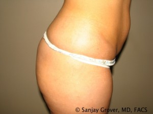 Butt Augmentation Before and After 03 | Sanjay Grover MD FACS