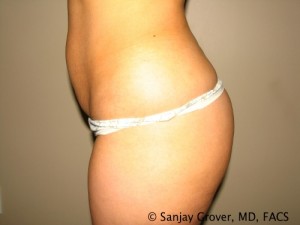 Butt Augmentation Before and After 03 | Grover Aesthetics