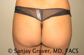 Butt Augmentation Before and After 01 | Grover Aesthetics