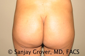 Butt Augmentation Before and After | Grover Aesthetics
