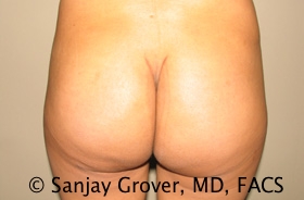 Butt Augmentation Before and After | Sanjay Grover MD FACS