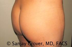 Butt Augmentation Before and After 04 | Sanjay Grover MD FACS