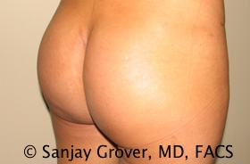 Butt Augmentation Before and After 04 | Sanjay Grover MD FACS