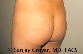 Butt Augmentation Before and After 04 | Sanjay Grover MD FACS