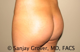 Butt Augmentation Before and After 04 | Grover Aesthetics