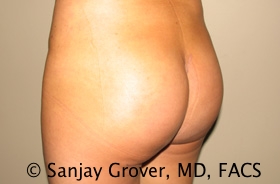 Butt Augmentation Before and After 04 | Sanjay Grover MD FACS