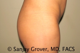 Butt Augmentation Before and After 04 | Grover Aesthetics