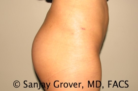 Butt Augmentation Before and After 04 | Grover Aesthetics