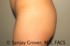 Butt Augmentation Before and After 04 | Grover Aesthetics