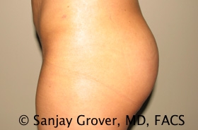 Butt Augmentation Before and After 04 | Sanjay Grover MD FACS