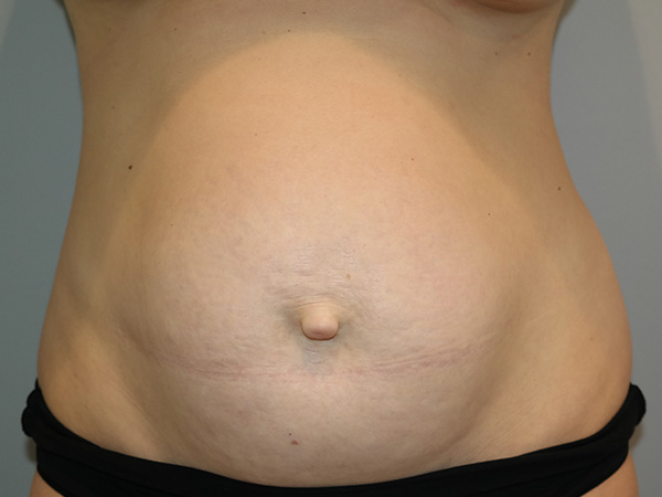 Diastasis Recti Before and After | Grover Aesthetics