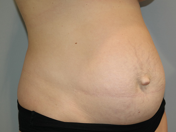Diastasis Recti Before and After 01 | Grover Aesthetics