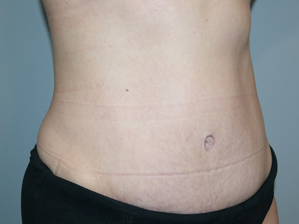 Diastasis Recti Before and After 01 | Grover Aesthetics