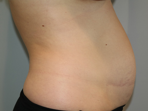 Diastasis Recti Before and After 01 | Grover Aesthetics