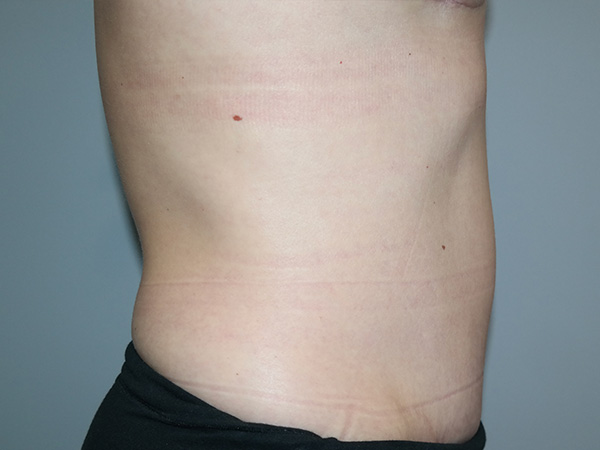Diastasis Recti Before and After 01 | Grover Aesthetics