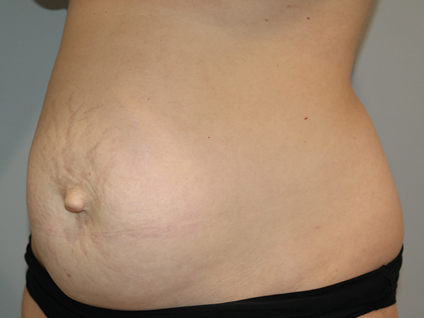 Diastasis Recti Before and After 01 | Grover Aesthetics