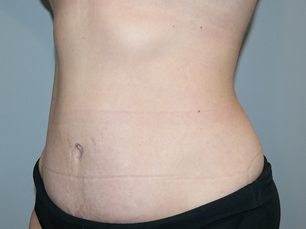Diastasis Recti Before and After 01 | Grover Aesthetics