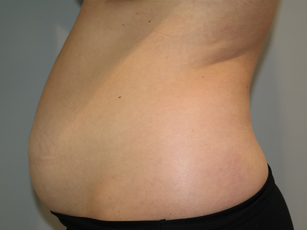 Diastasis Recti Before and After 01 | Grover Aesthetics