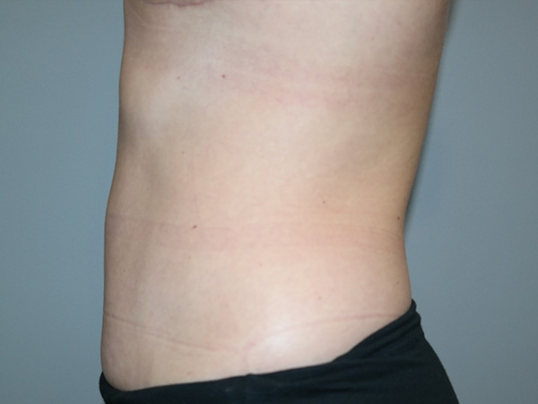 Diastasis Recti Before and After 01 | Grover Aesthetics