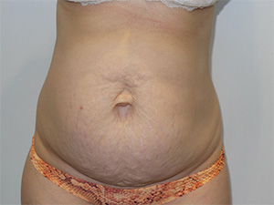 Diastasis Recti Before and After | Grover Aesthetics