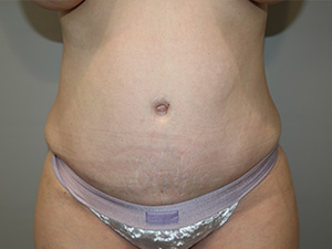 Diastasis Recti Before and After | Grover Aesthetics