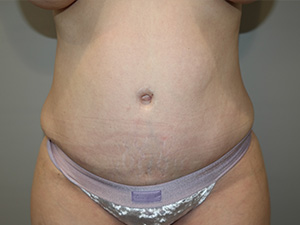 Diastasis Recti Surgery Orange County