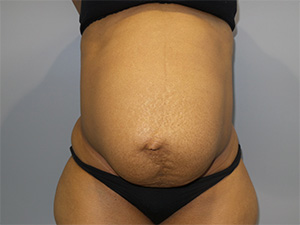 Diastasis Recti Before and After | Grover Aesthetics