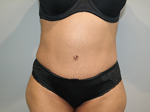 Diastasis Recti Before and After | Grover Aesthetics