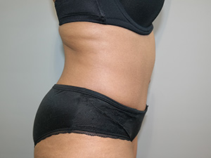 Diastasis Recti Before and After 03 | Grover Aesthetics