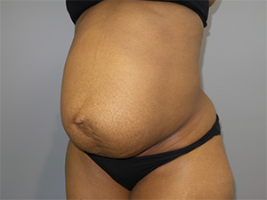 Diastasis Recti Before and After 03 | Grover Aesthetics