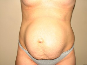 Diastasis Recti Before and After | Grover Aesthetics