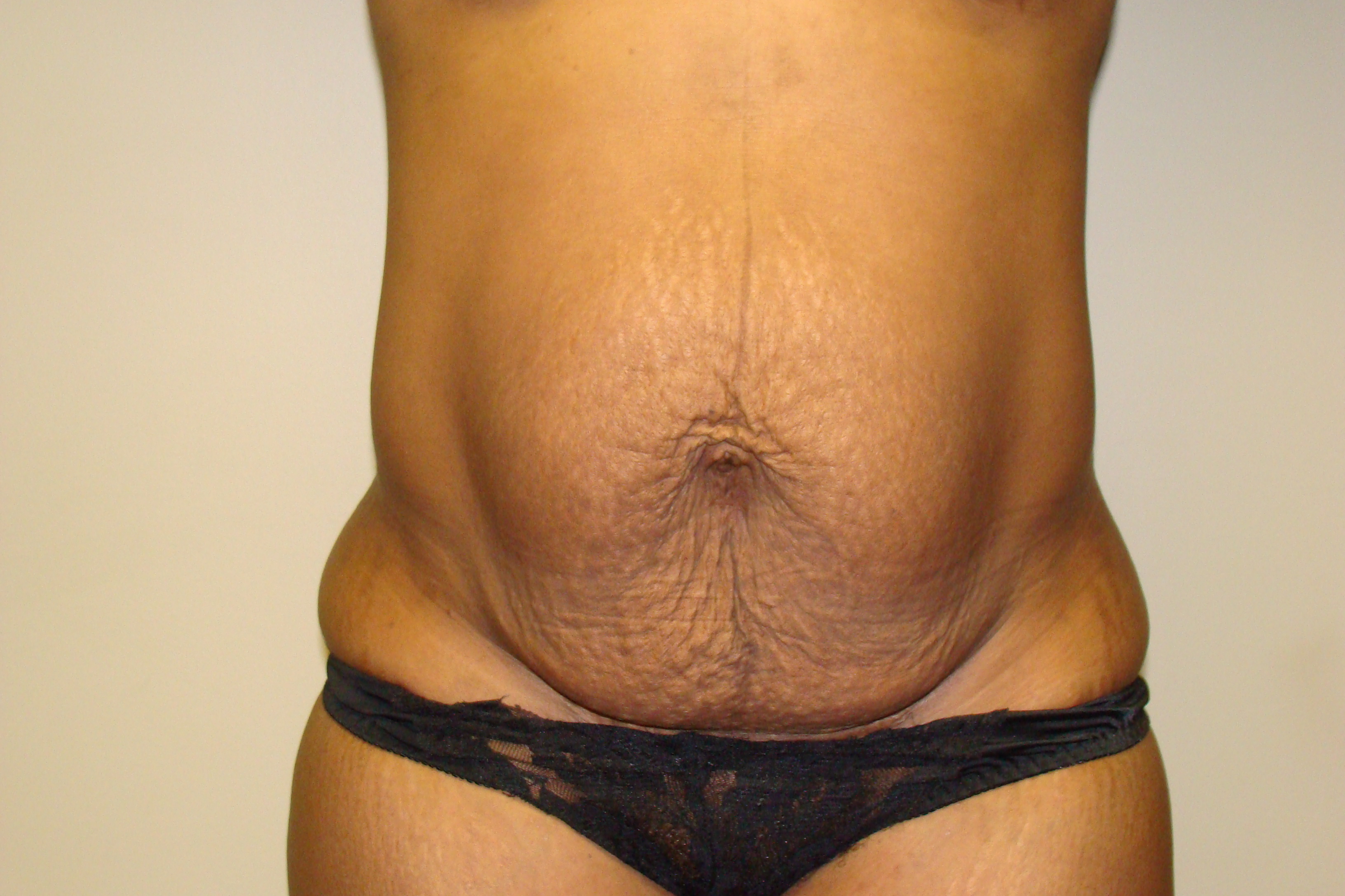 Diastasis Recti Before and After | Grover Aesthetics