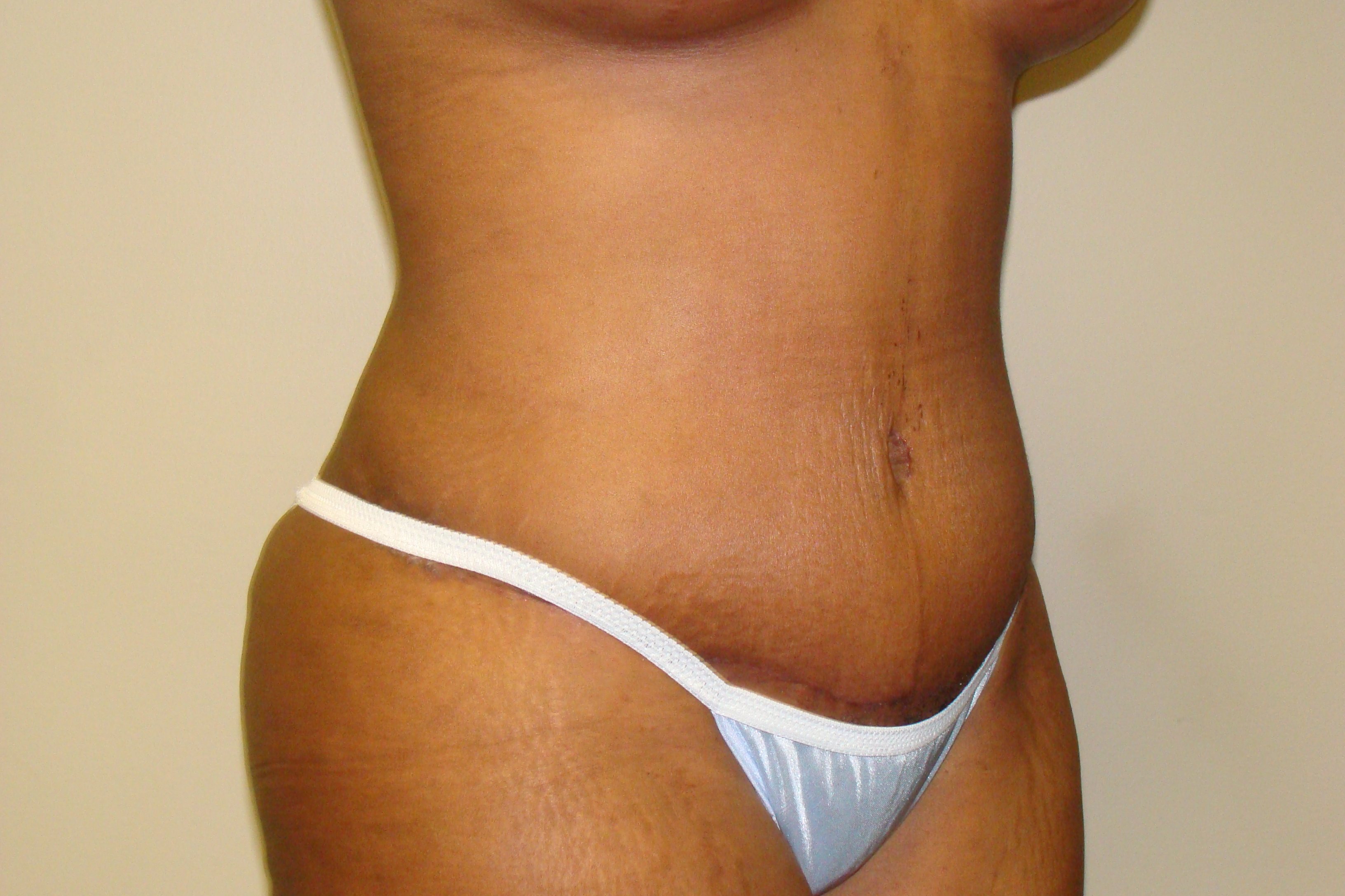 Diastasis Recti Before and After 05 | Grover Aesthetics
