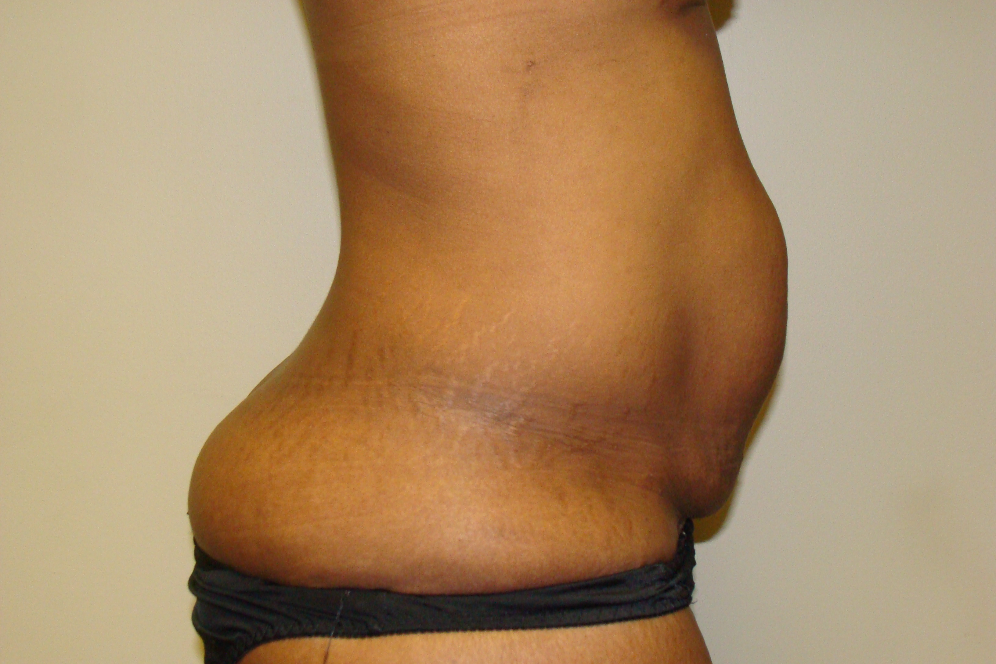 Diastasis Recti Before and After 05 | Grover Aesthetics