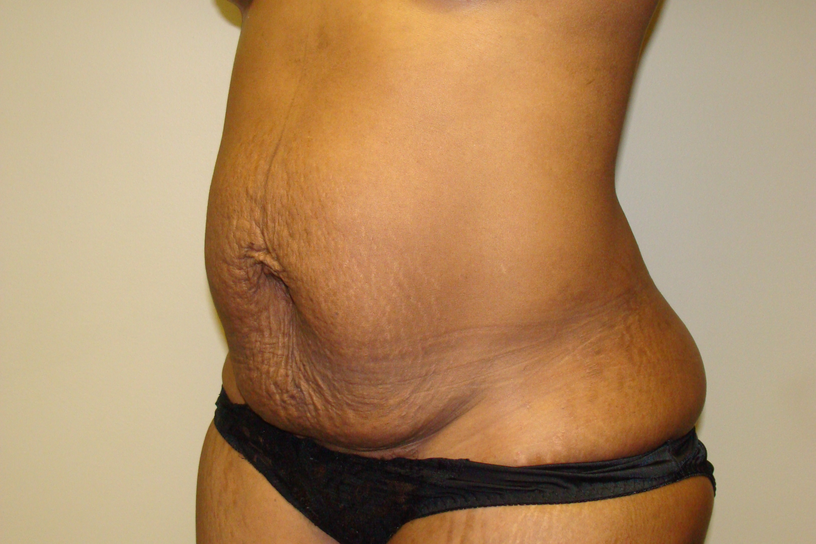 Diastasis Recti Before and After 05 | Grover Aesthetics