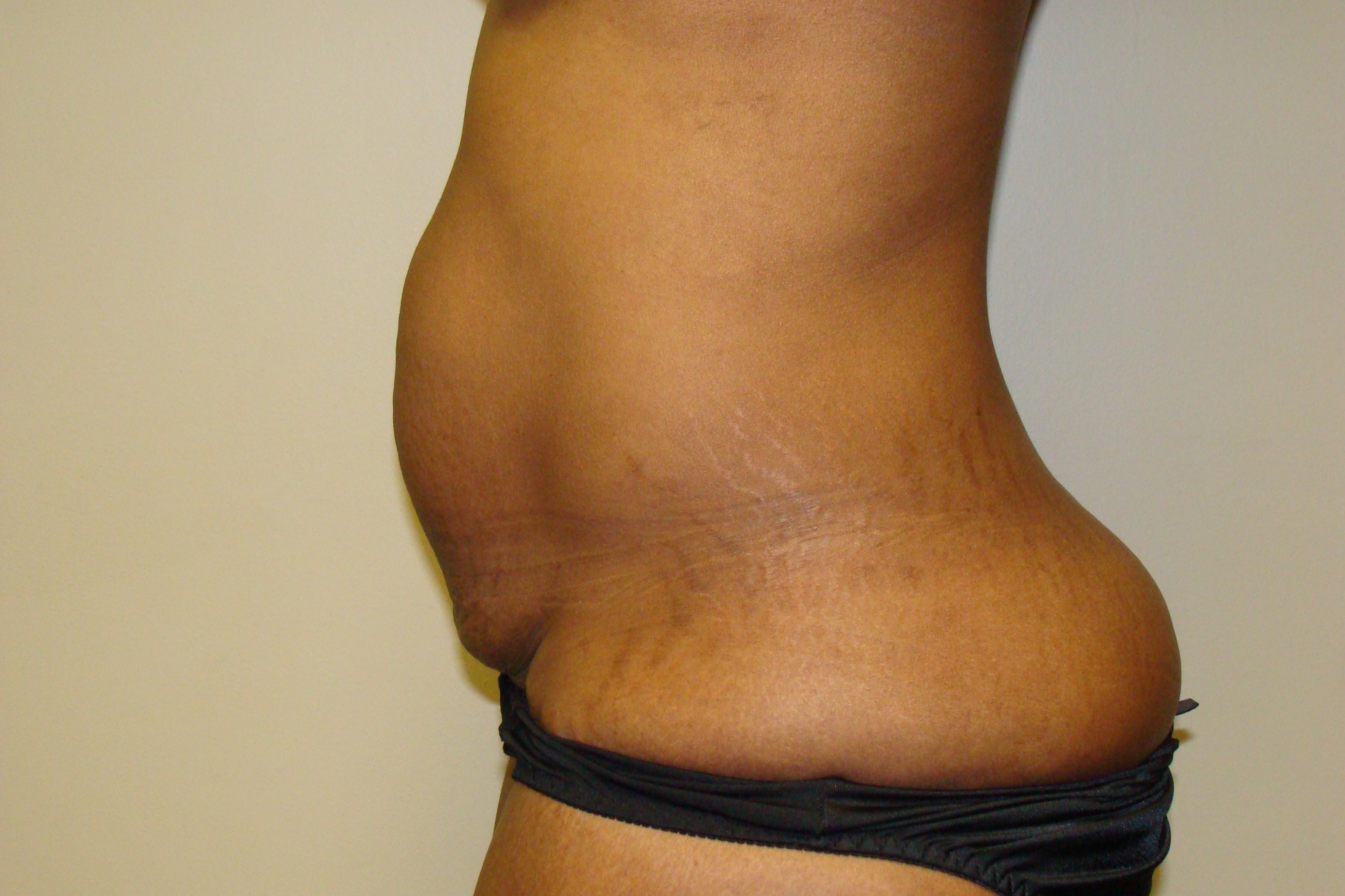 Diastasis Recti Before and After 05 | Grover Aesthetics