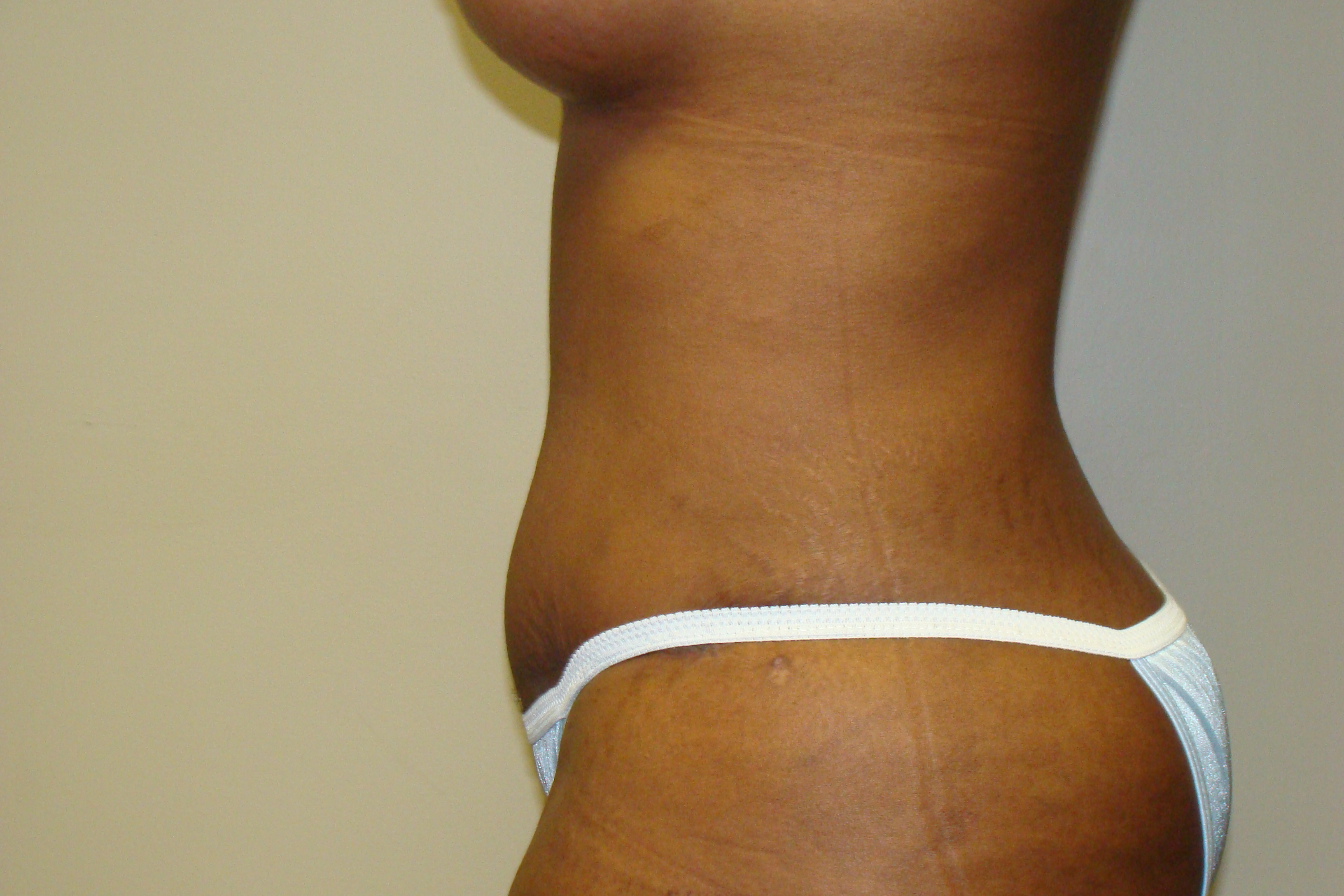 Diastasis Recti Before and After 05 | Grover Aesthetics