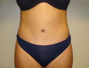 Diastasis Recti Before and After | Grover Aesthetics