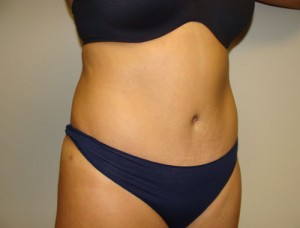 Diastasis Recti Before and After 06 | Grover Aesthetics