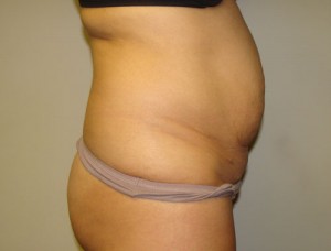 Diastasis Recti Before and After 06 | Grover Aesthetics
