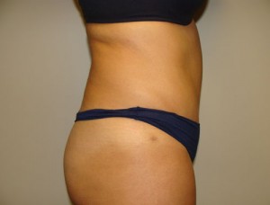 Diastasis Recti Before and After 06 | Grover Aesthetics